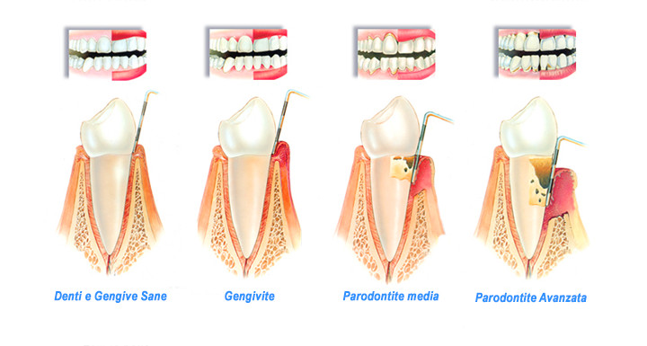 Parodontite